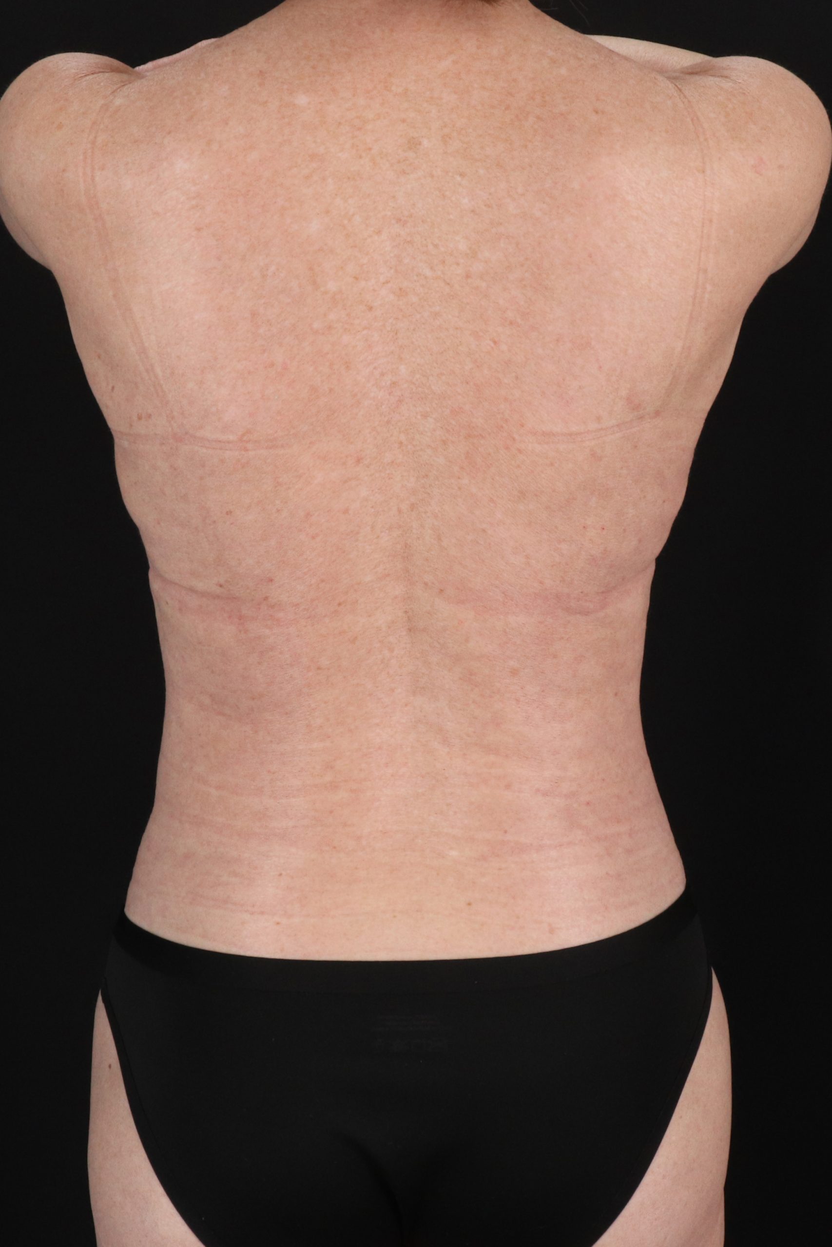 All Me Augmentation Before & After Patient #10280