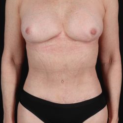 All Me Augmentation Before & After Patient #10280