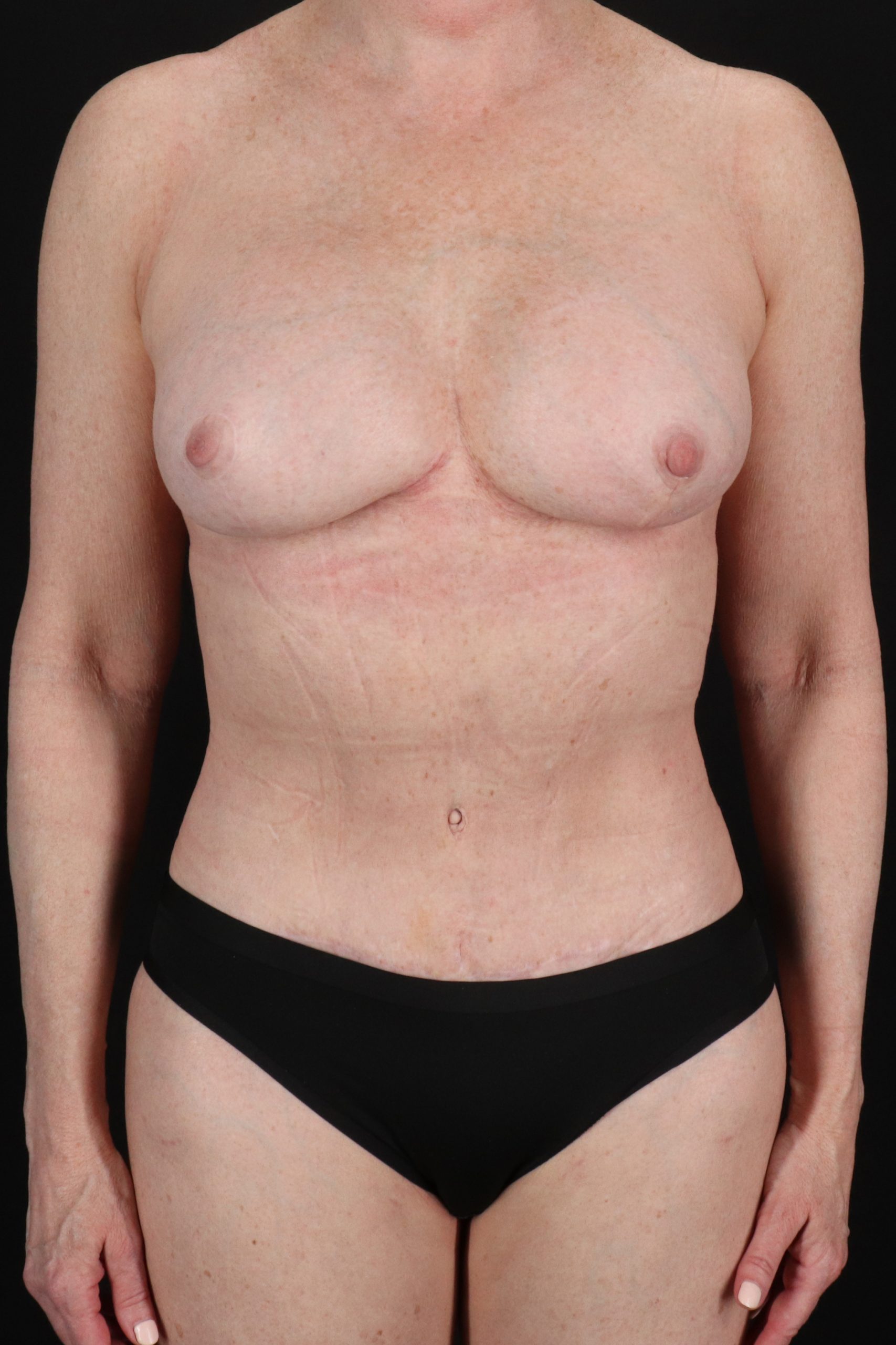 All Me Augmentation Before & After Patient #10280