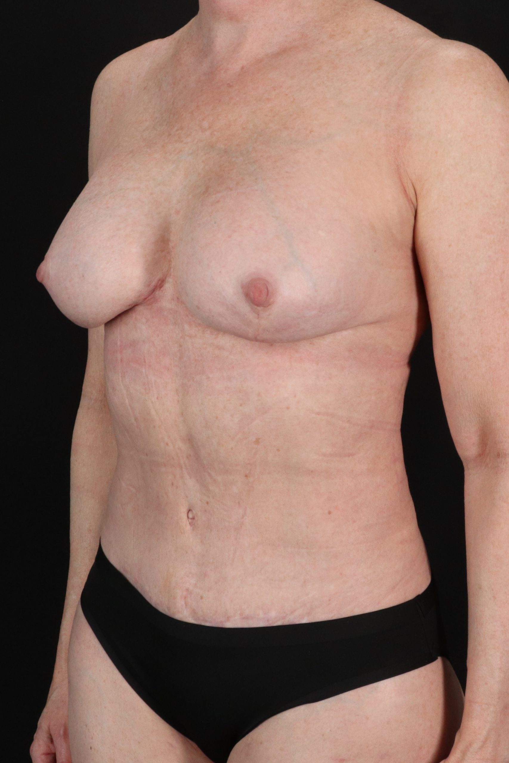 All Me Augmentation Before & After Patient #10280
