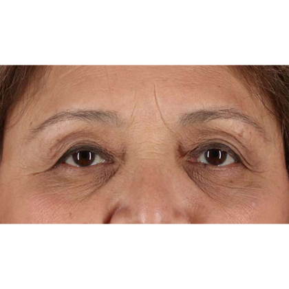 Blepharoplasty (Eyelid Surgery) Before & After Patient #10760