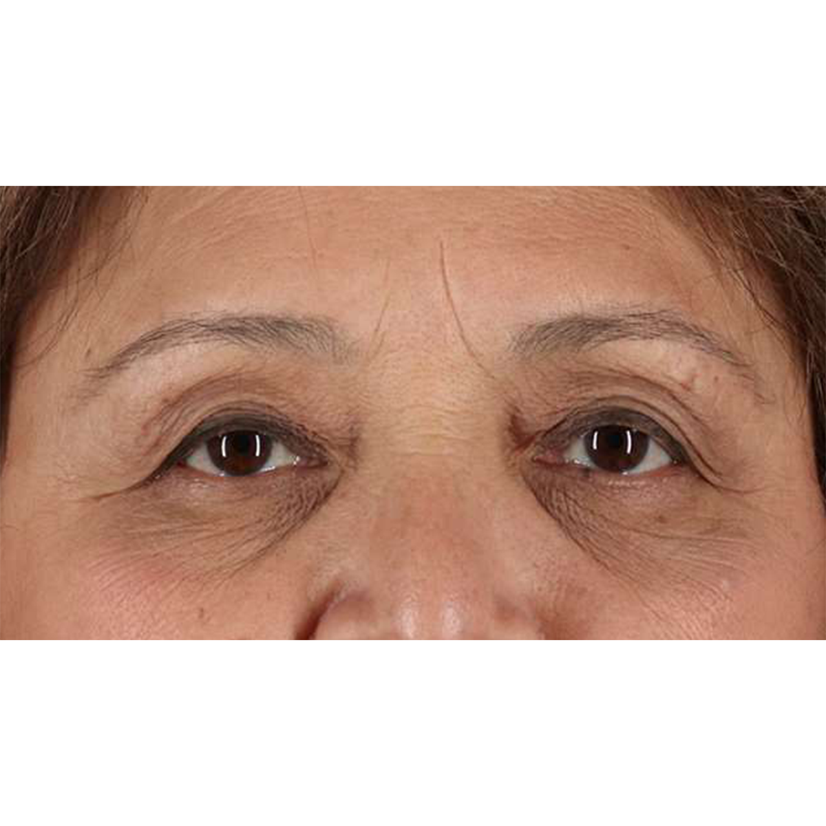 Blepharoplasty (Eyelid Surgery) Before & After Patient #10760