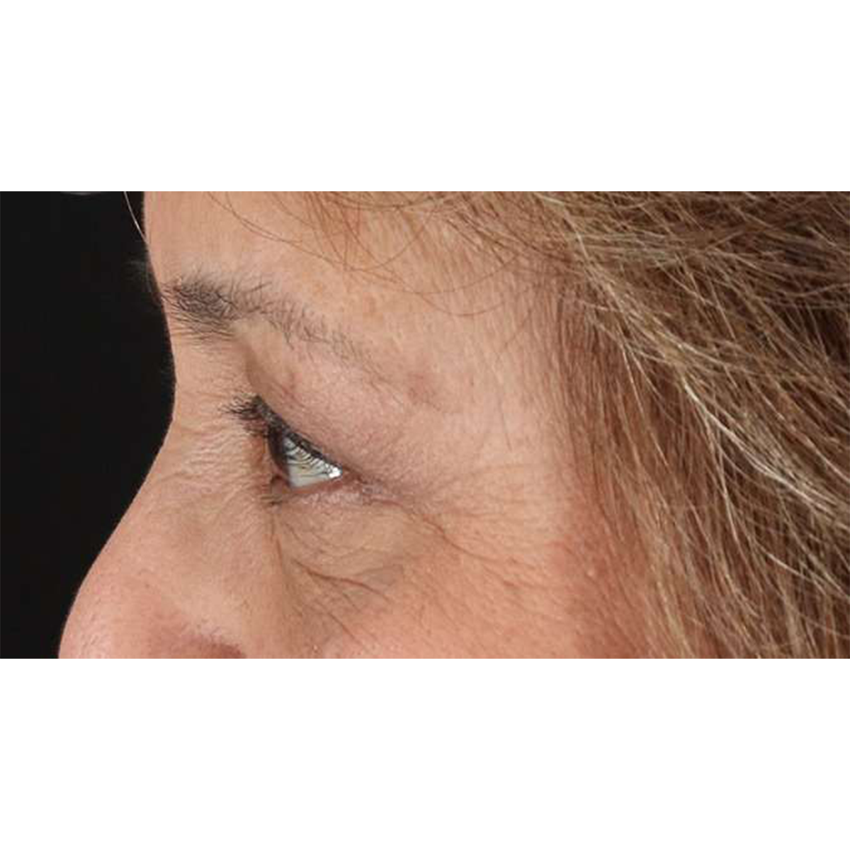 Blepharoplasty (Eyelid Surgery) Before & After Patient #10760