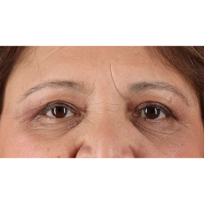 Blepharoplasty (Eyelid Surgery) Before & After Patient #10760