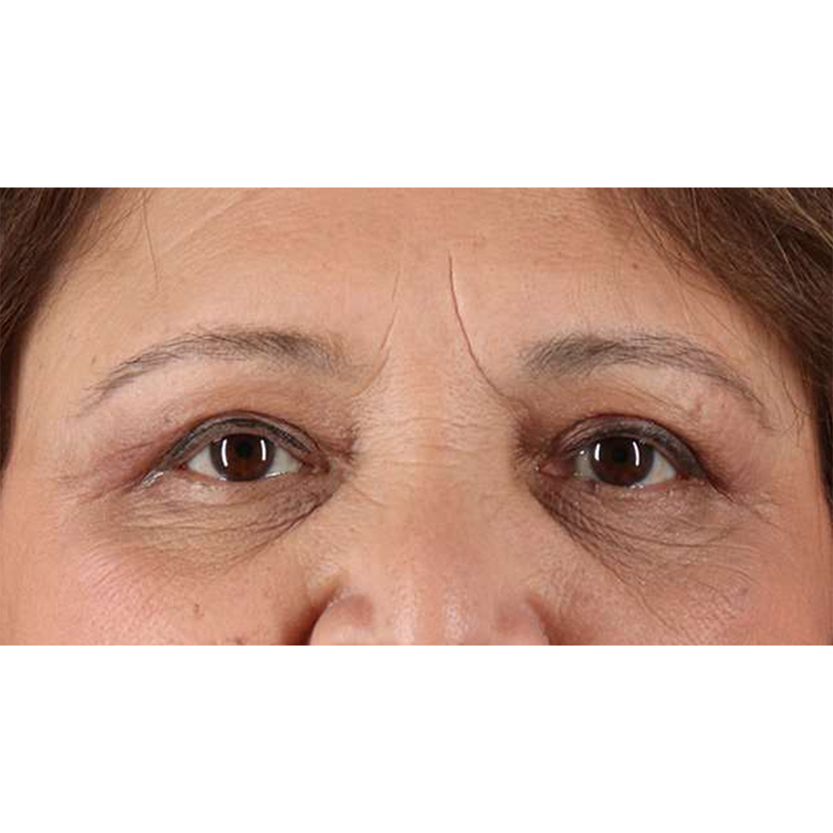 Blepharoplasty (Eyelid Surgery) Before & After Patient #10760