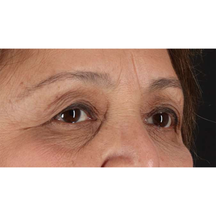 Blepharoplasty (Eyelid Surgery) Before & After Patient #10760