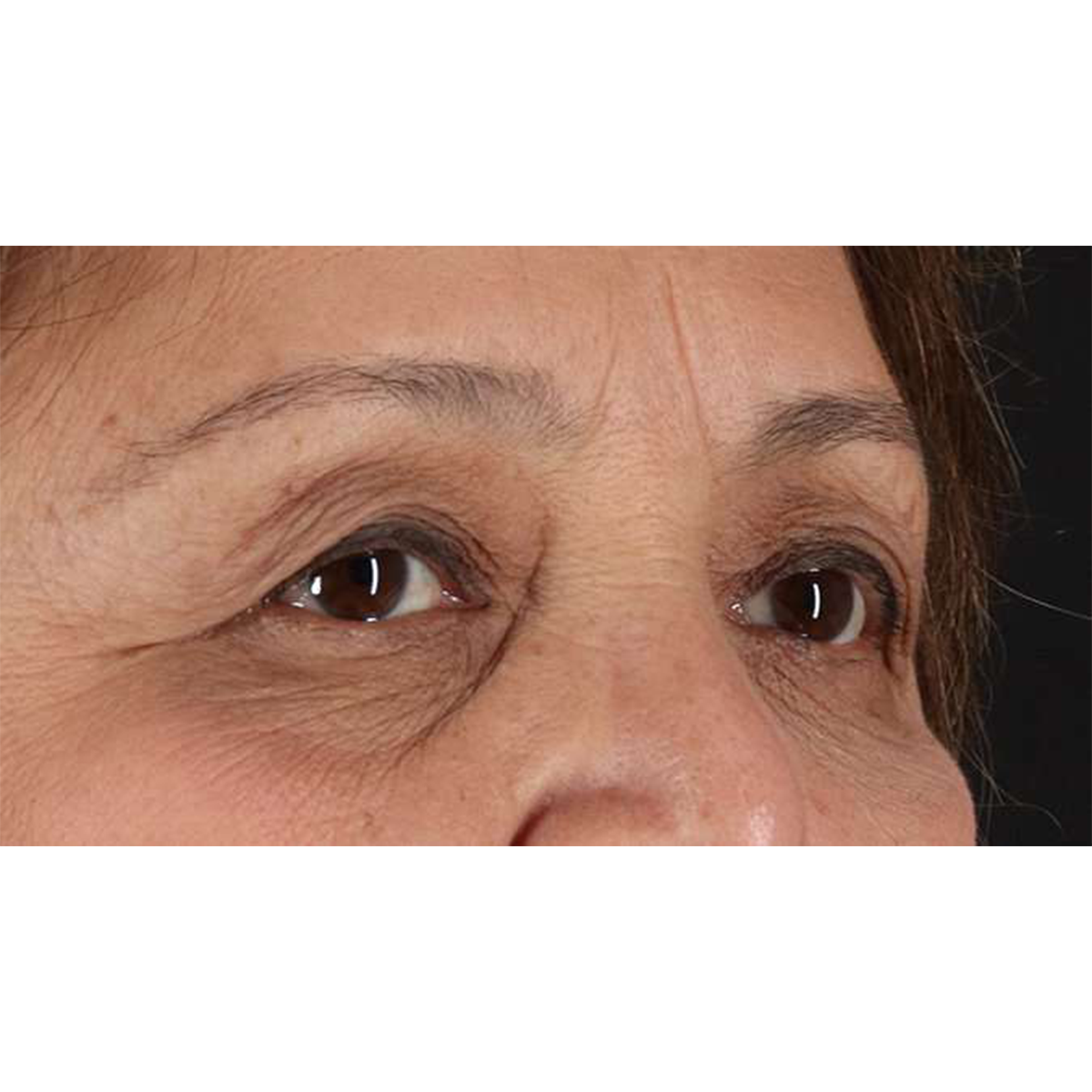 Blepharoplasty (Eyelid Surgery) Before & After Patient #10760