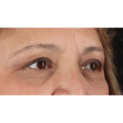 Blepharoplasty (Eyelid Surgery) Before & After Patient #10760
