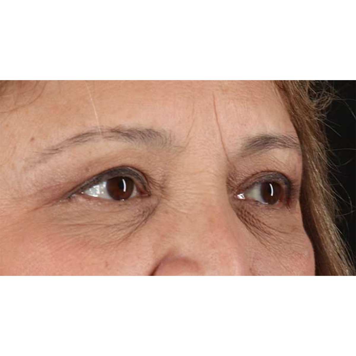 Blepharoplasty (Eyelid Surgery) Before & After Patient #10760