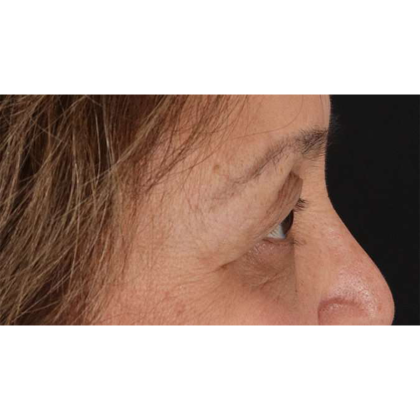 Blepharoplasty (Eyelid Surgery) Before & After Patient #10760
