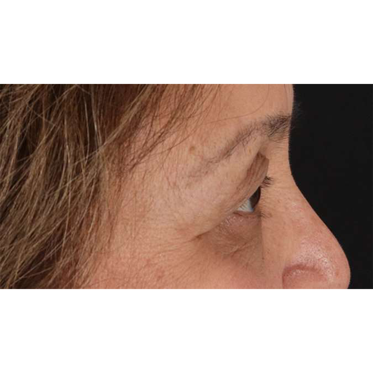 Blepharoplasty (Eyelid Surgery) Before & After Patient #10760