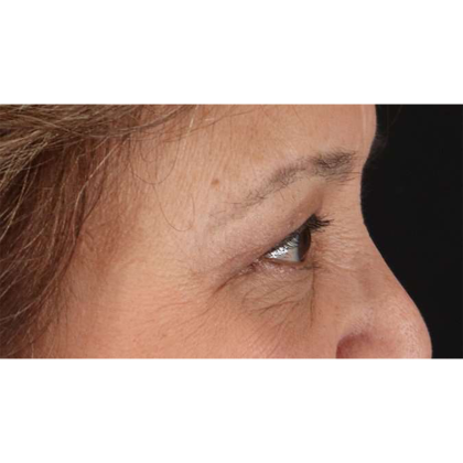 Blepharoplasty (Eyelid Surgery) Before & After Patient #10760