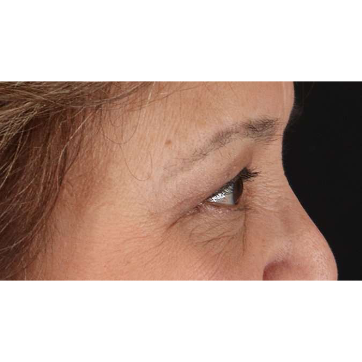 Blepharoplasty (Eyelid Surgery) Before & After Patient #10760