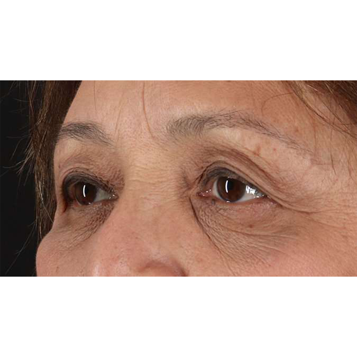 Blepharoplasty (Eyelid Surgery) Before & After Patient #10760
