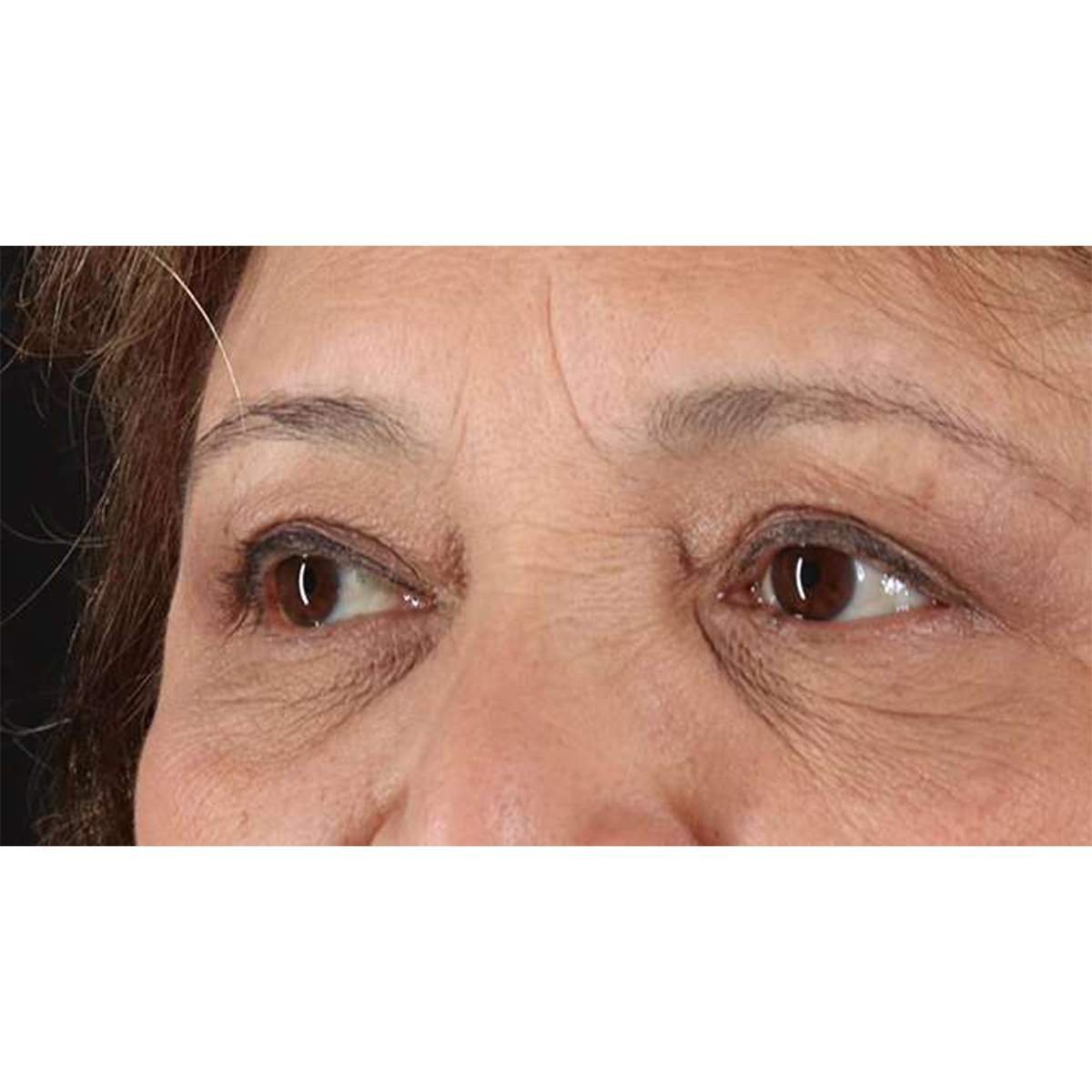 Blepharoplasty (Eyelid Surgery) Before & After Patient #10760