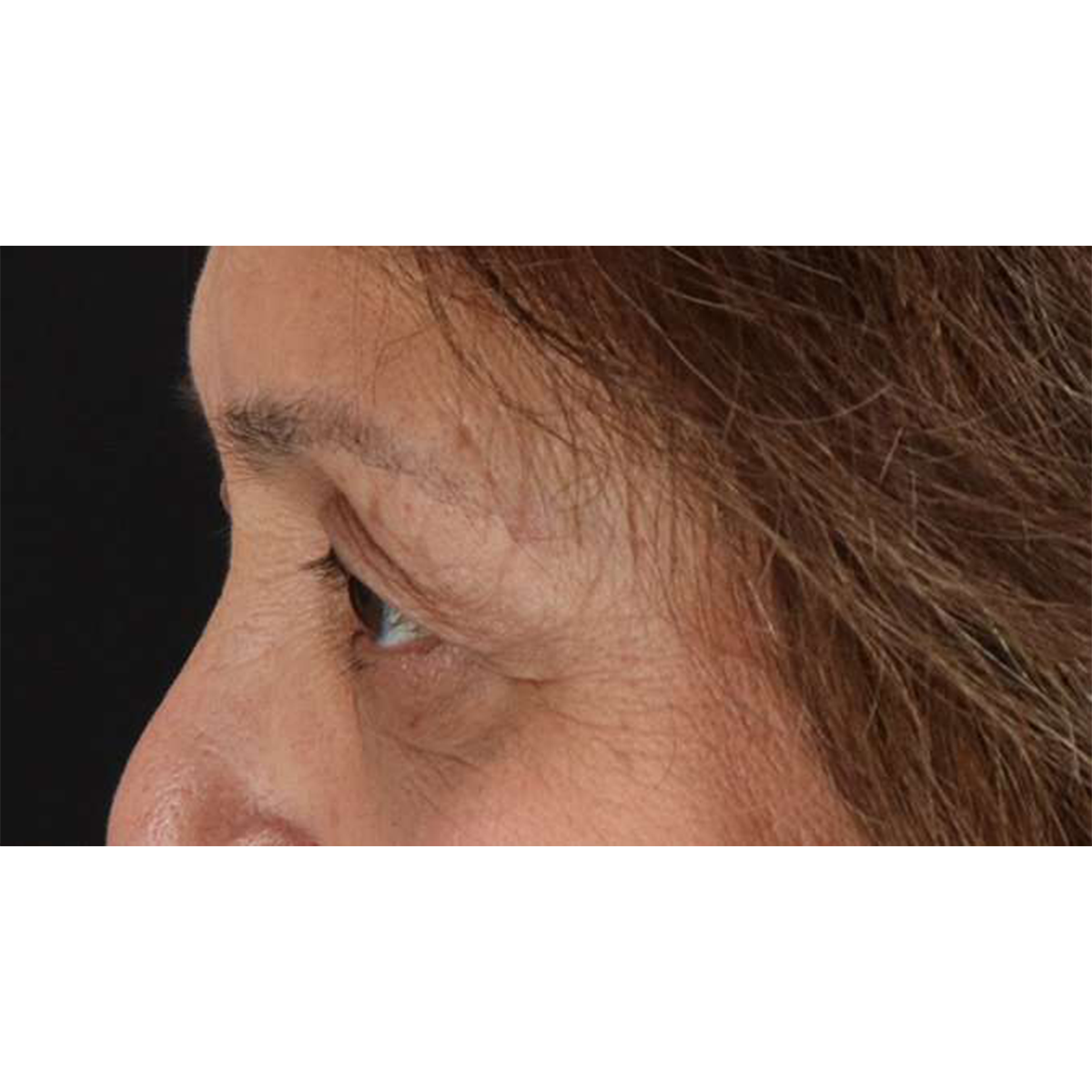 Blepharoplasty (Eyelid Surgery) Before & After Patient #10760