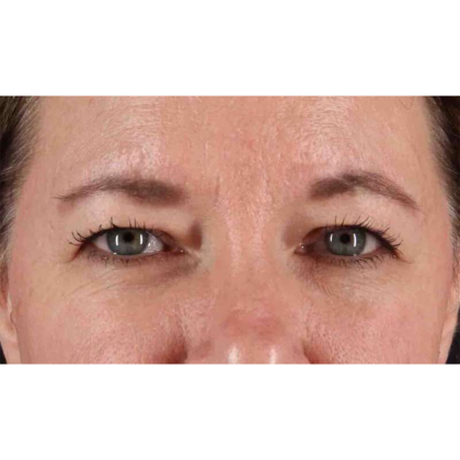 Blepharoplasty (Eyelid Surgery) Before & After Patient #10749
