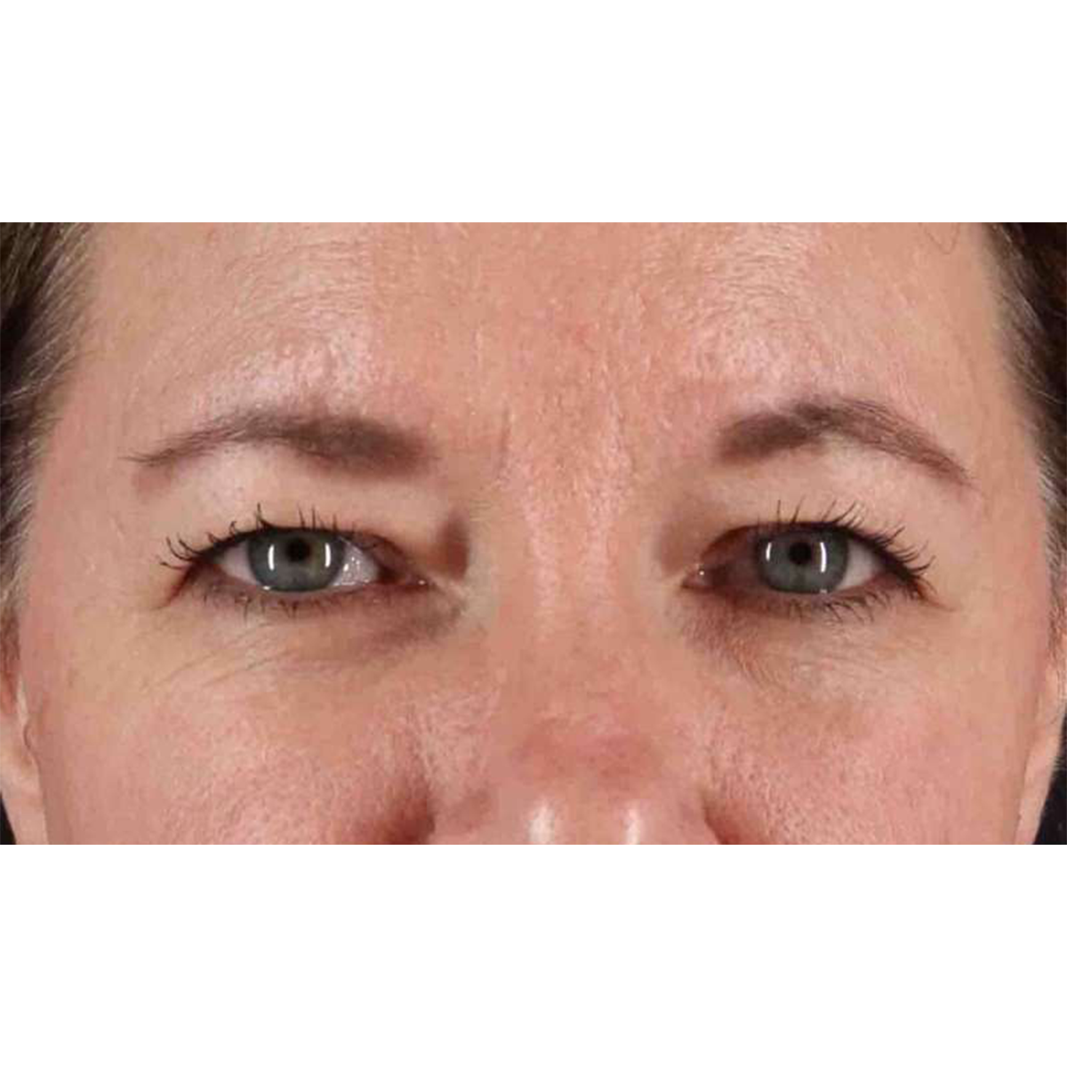 Blepharoplasty (Eyelid Surgery) Before & After Patient #10749