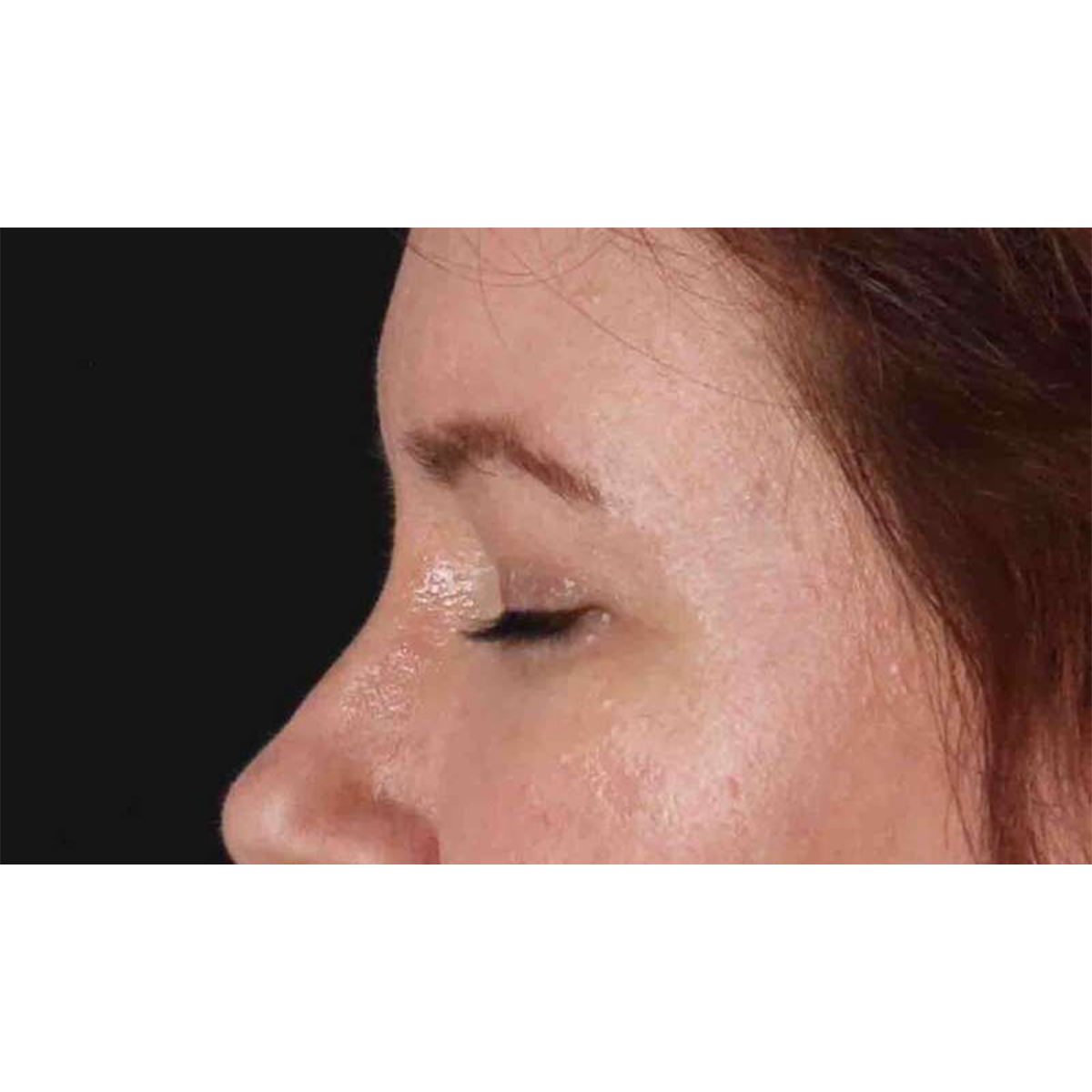 Blepharoplasty (Eyelid Surgery) Before & After Patient #10749