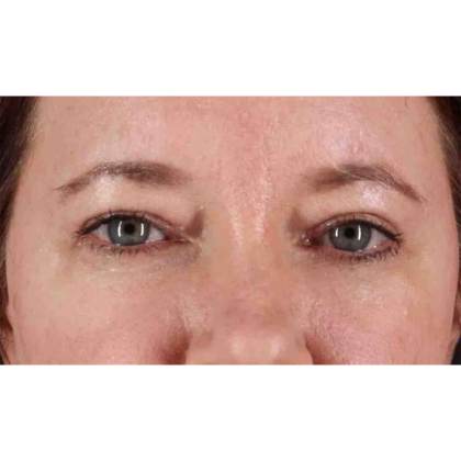 Blepharoplasty (Eyelid Surgery) Before & After Patient #10749
