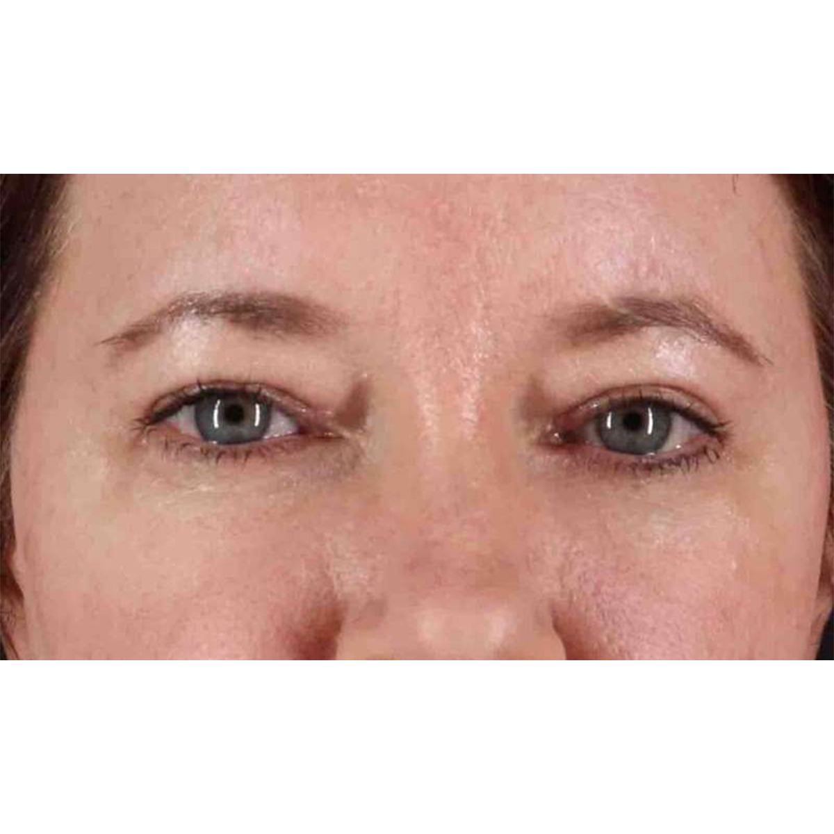 Blepharoplasty (Eyelid Surgery) Before & After Patient #10749