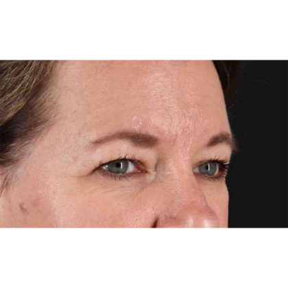 Blepharoplasty (Eyelid Surgery) Before & After Patient #10749