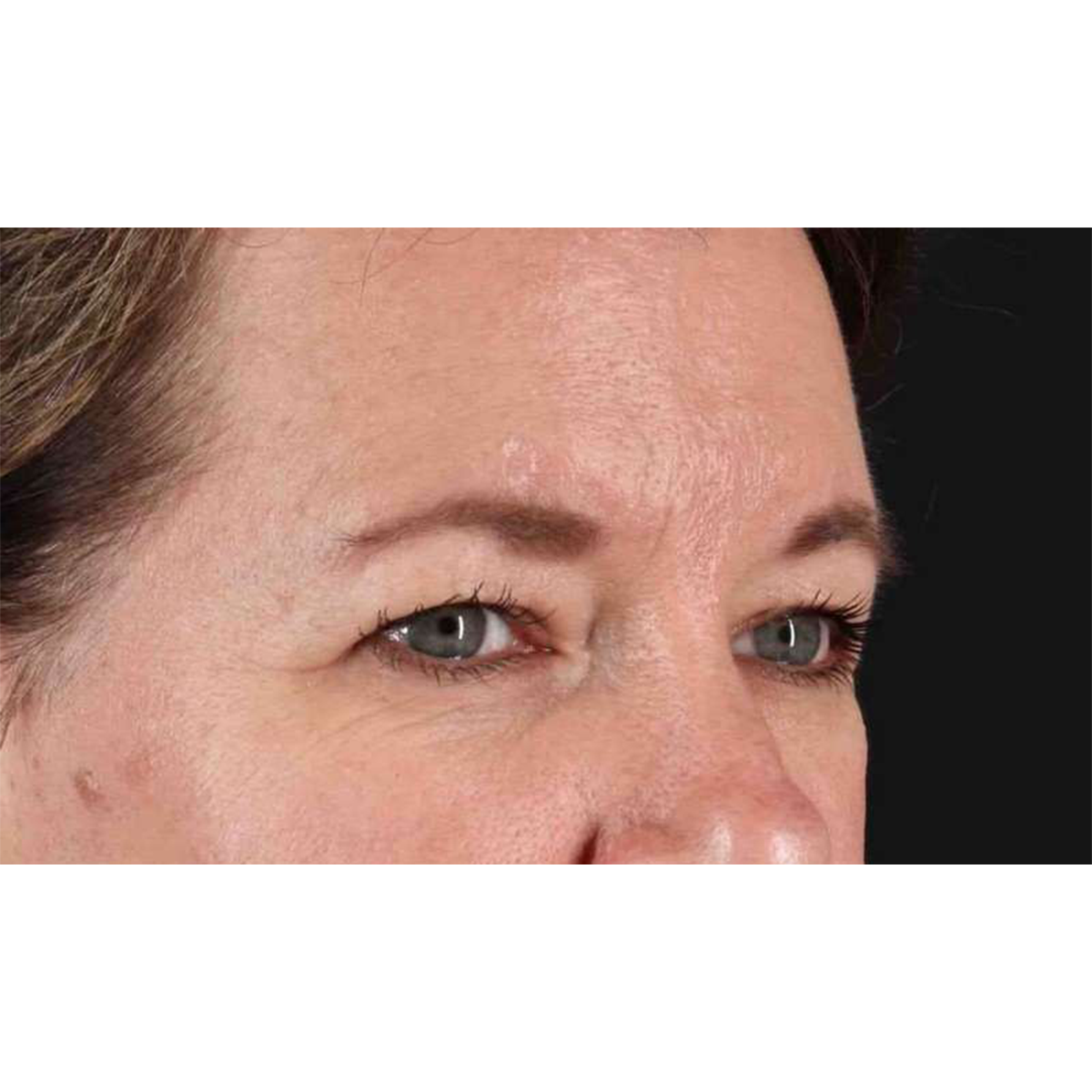 Blepharoplasty (Eyelid Surgery) Before & After Patient #10749