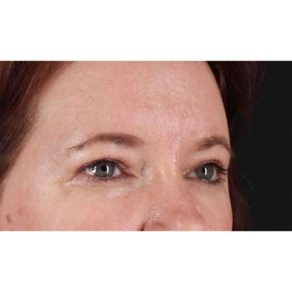 Blepharoplasty (Eyelid Surgery) Before & After Patient #10749