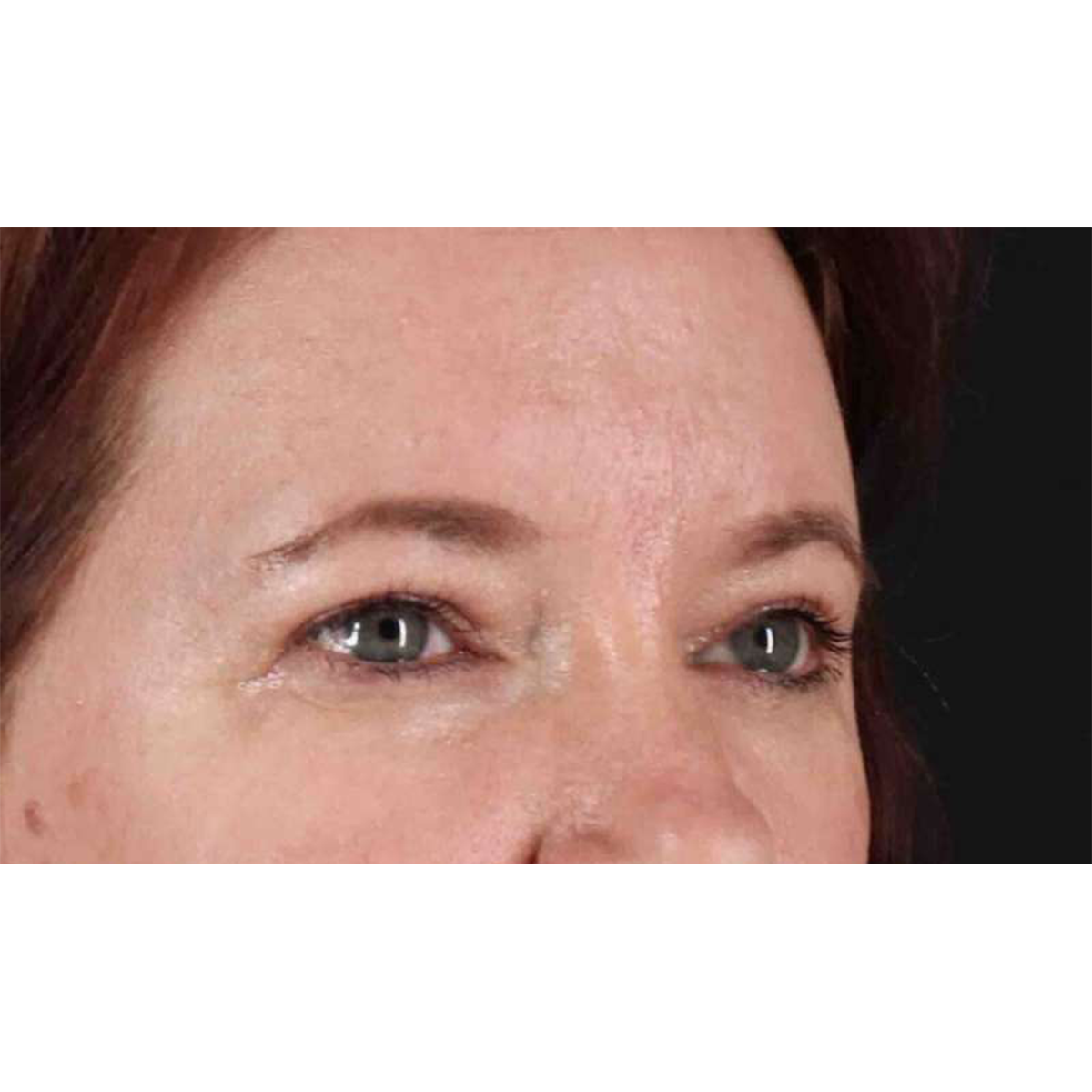 Blepharoplasty (Eyelid Surgery) Before & After Patient #10749