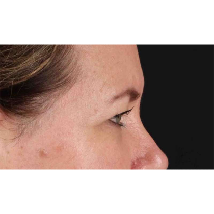 Blepharoplasty (Eyelid Surgery) Before & After Patient #10749
