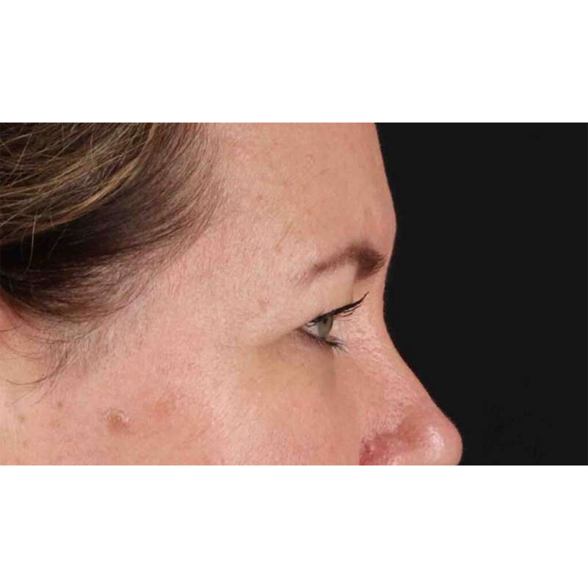 Blepharoplasty (Eyelid Surgery) Before & After Patient #10749