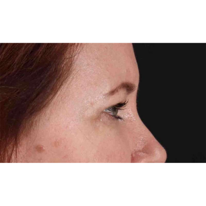 Blepharoplasty (Eyelid Surgery) Before & After Patient #10749