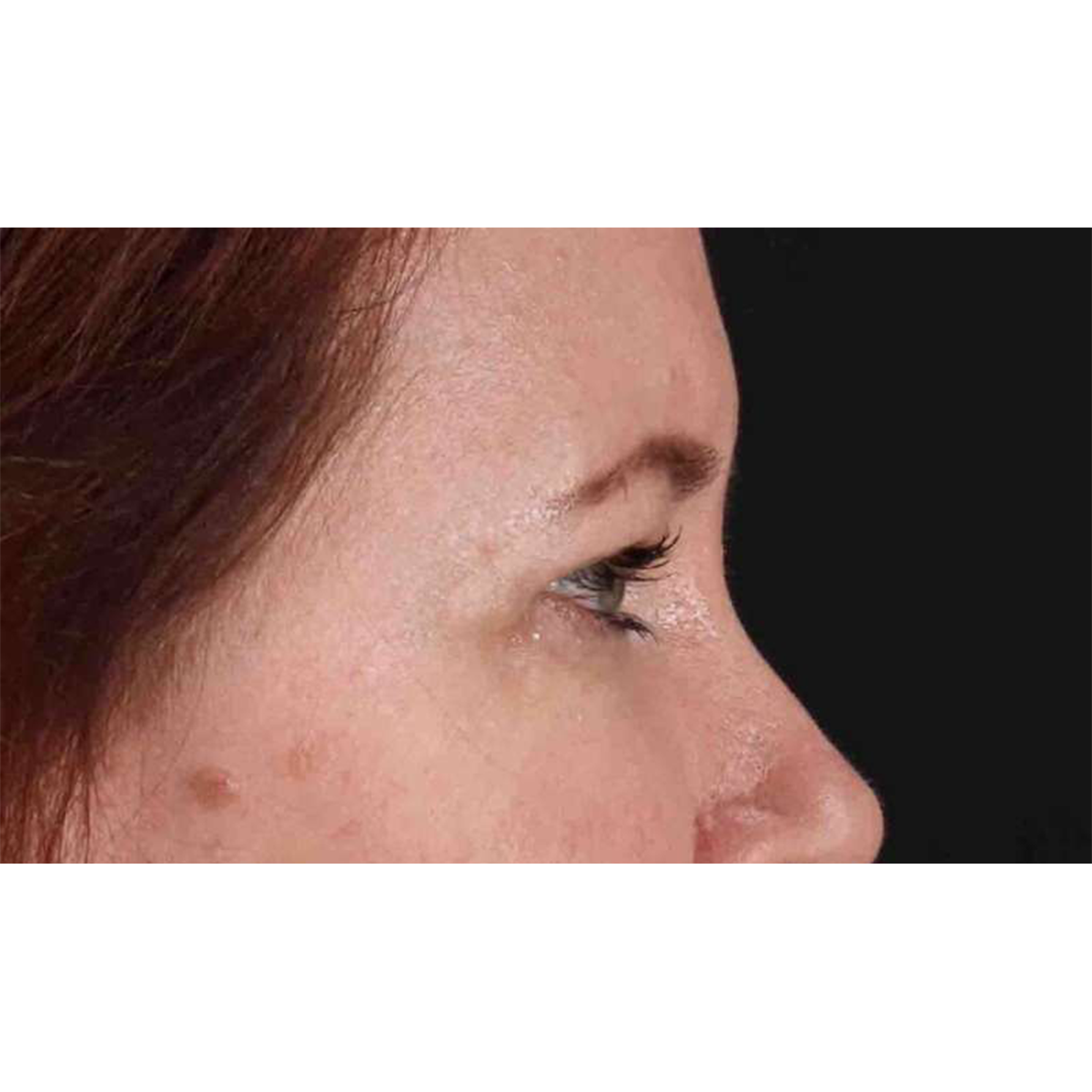 Blepharoplasty (Eyelid Surgery) Before & After Patient #10749