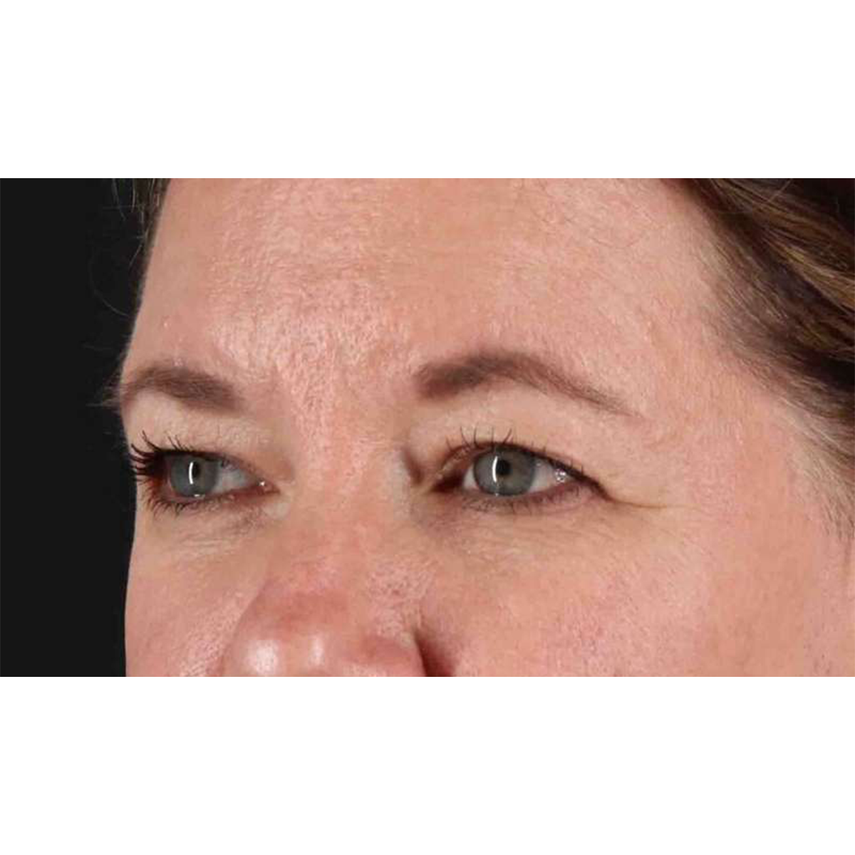 Blepharoplasty (Eyelid Surgery) Before & After Patient #10749