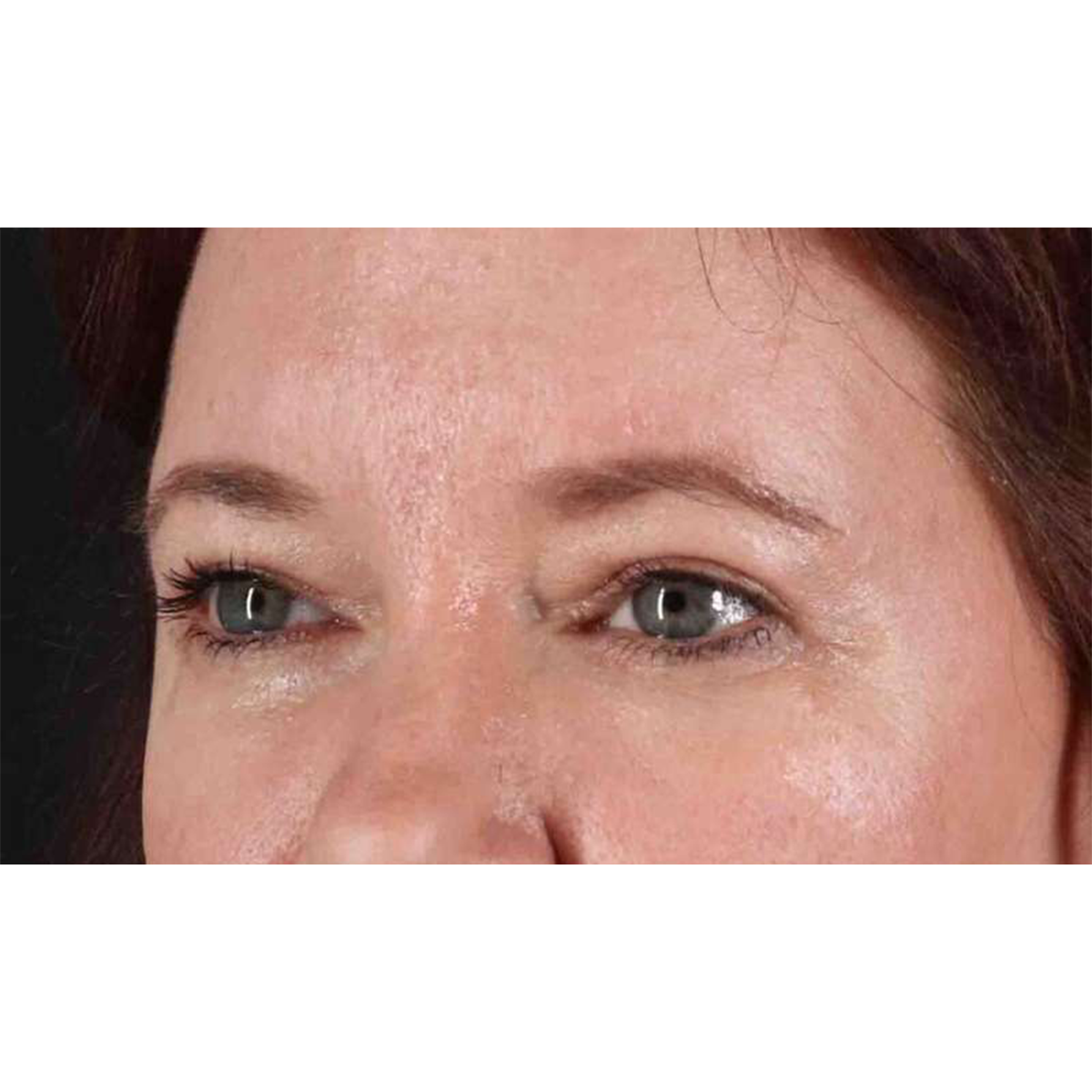 Blepharoplasty (Eyelid Surgery) Before & After Patient #10749
