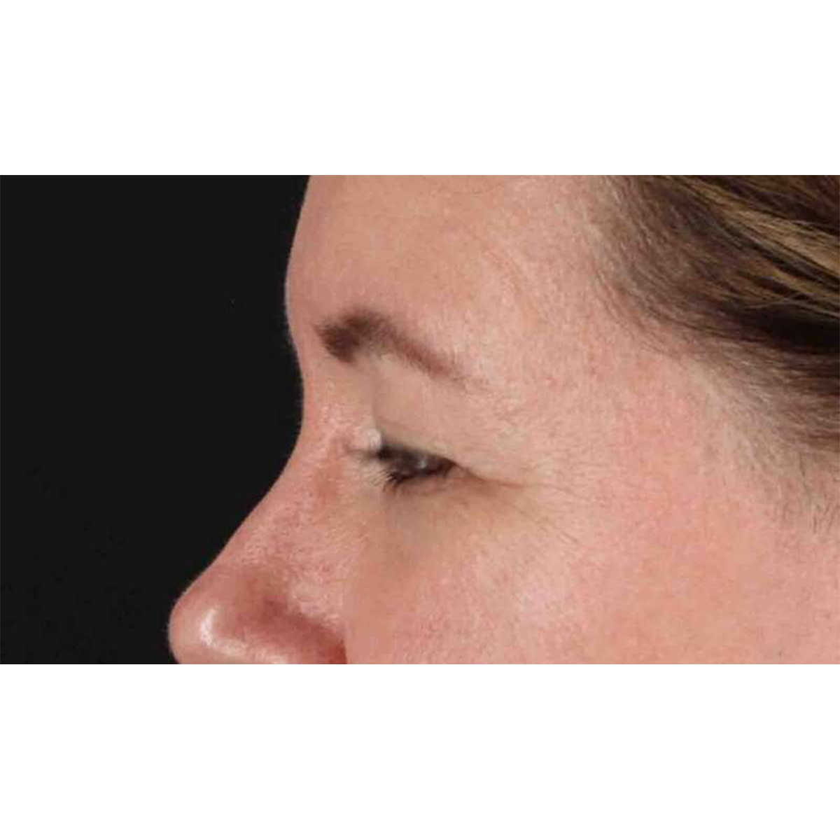 Blepharoplasty (Eyelid Surgery) Before & After Patient #10749
