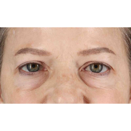 Blepharoplasty (Eyelid Surgery) Before & After Patient #10738