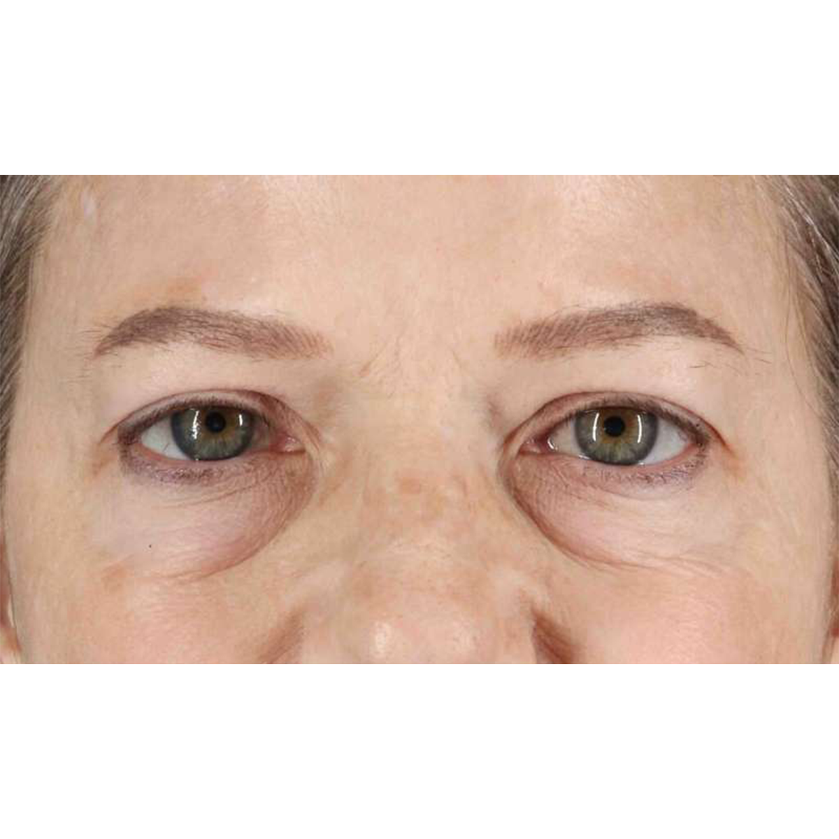 Blepharoplasty (Eyelid Surgery) Before & After Patient #10738