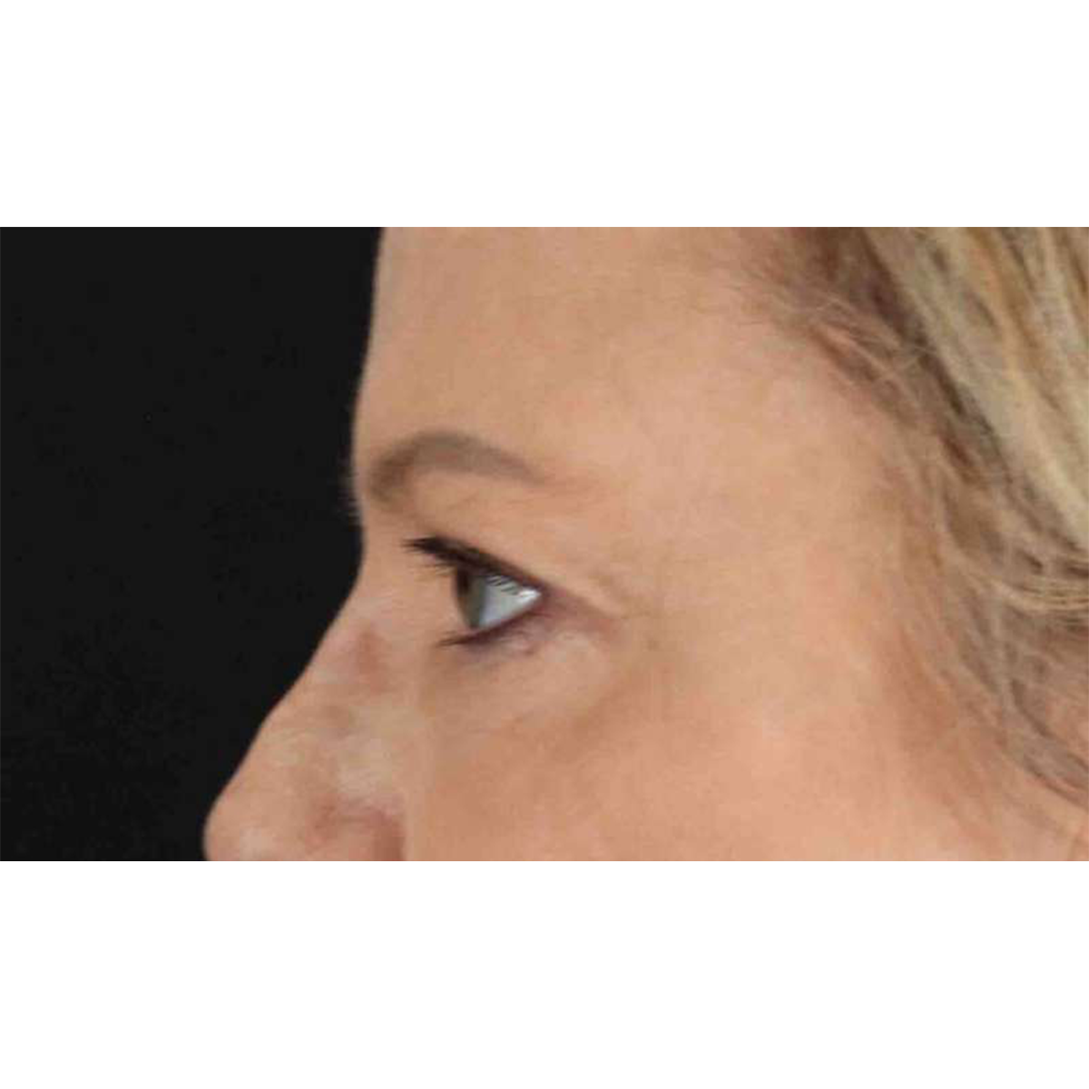 Blepharoplasty (Eyelid Surgery) Before & After Patient #10738