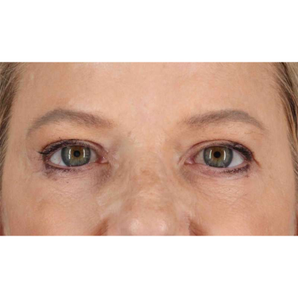 Blepharoplasty (Eyelid Surgery) Before & After Patient #10738