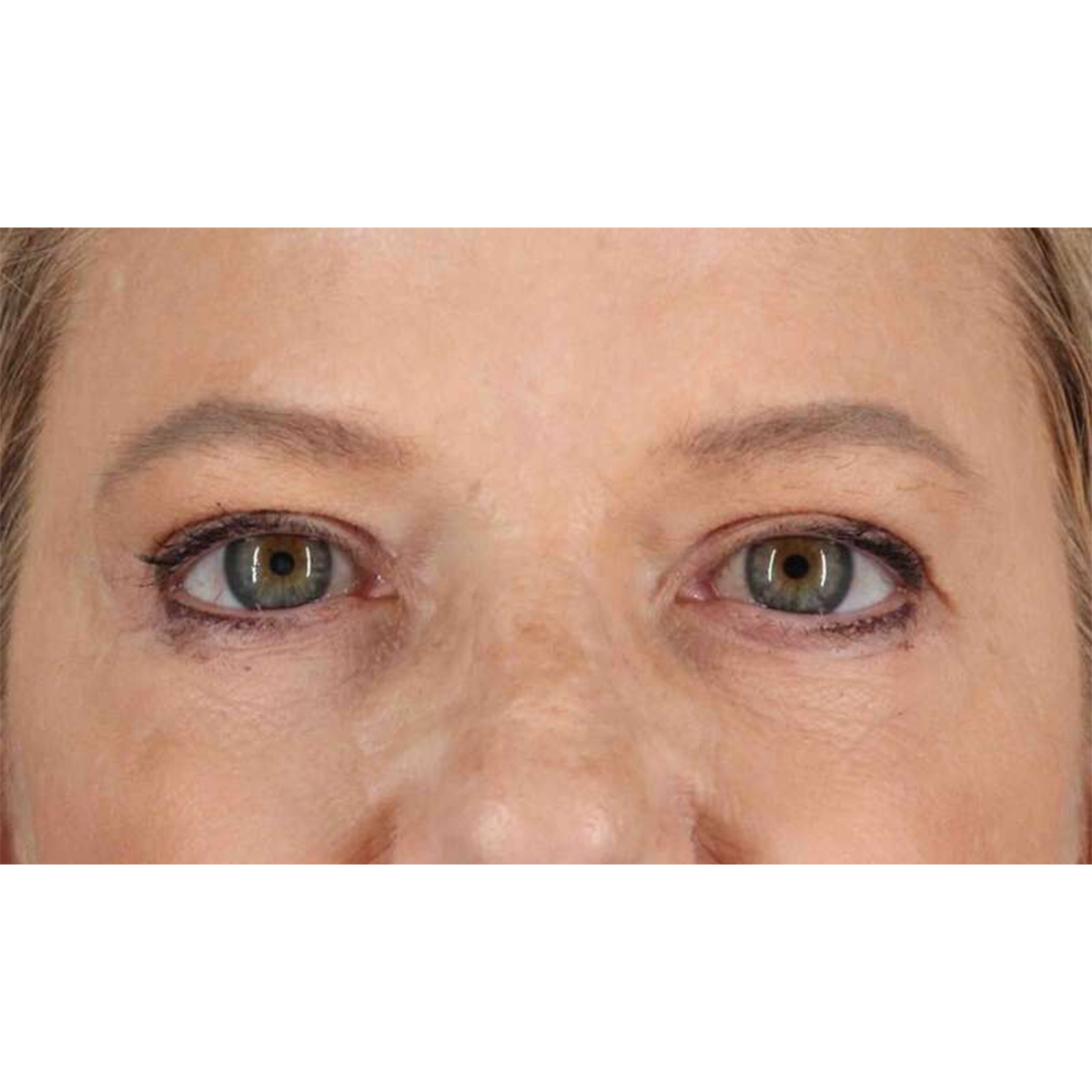 Blepharoplasty (Eyelid Surgery) Before & After Patient #10738