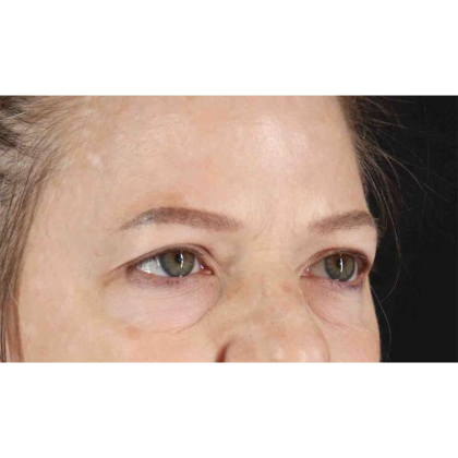 Blepharoplasty (Eyelid Surgery) Before & After Patient #10738