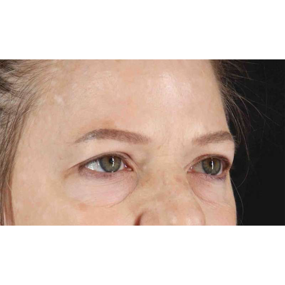 Blepharoplasty (Eyelid Surgery) Before & After Patient #10738