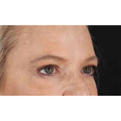 Blepharoplasty (Eyelid Surgery) Before & After Patient #10738