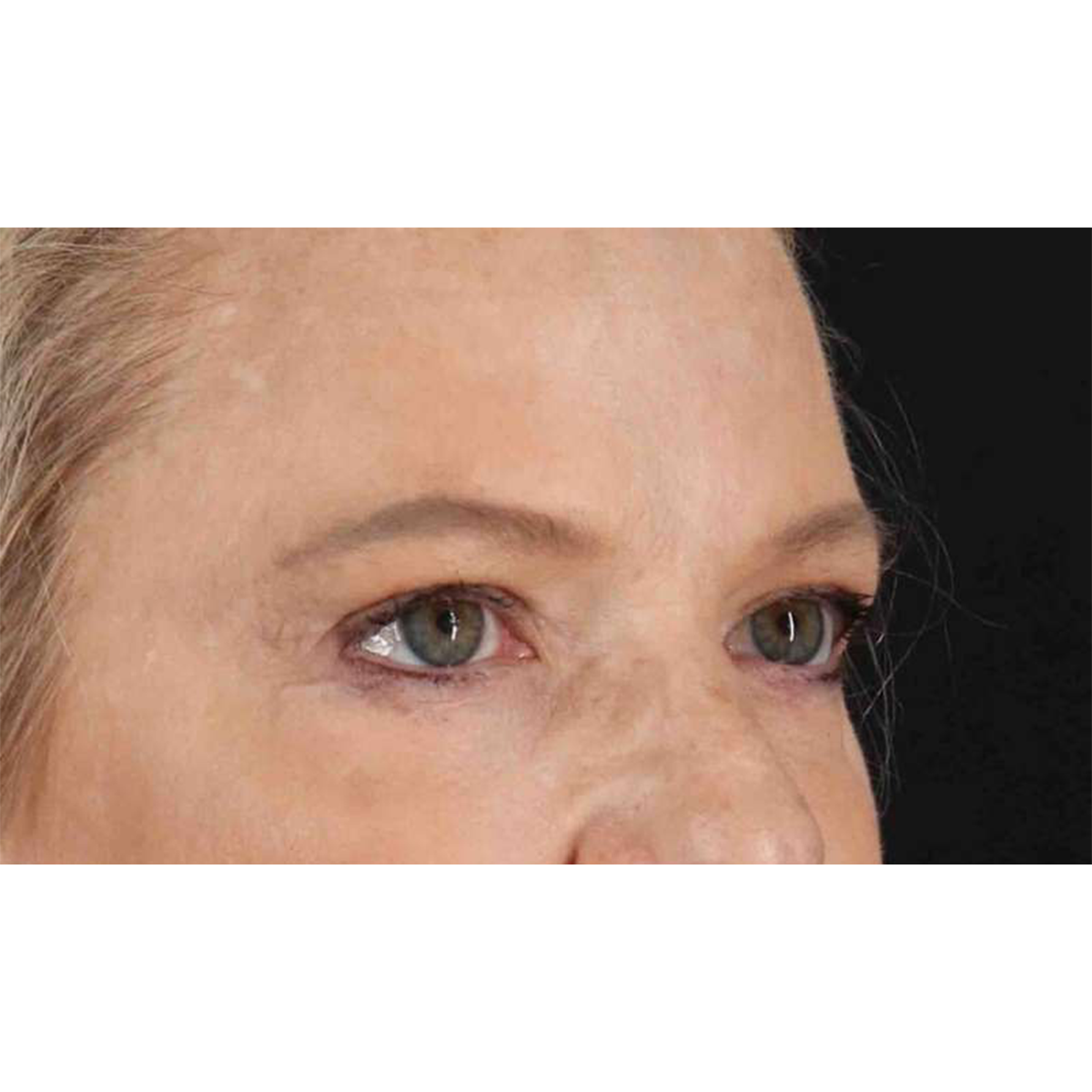 Blepharoplasty (Eyelid Surgery) Before & After Patient #10738