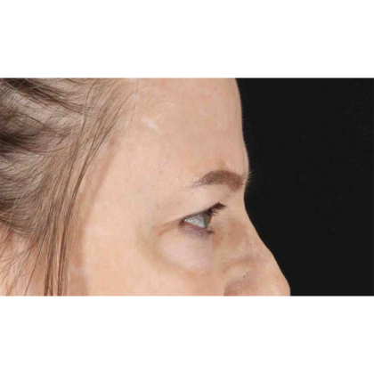 Blepharoplasty (Eyelid Surgery) Before & After Patient #10738