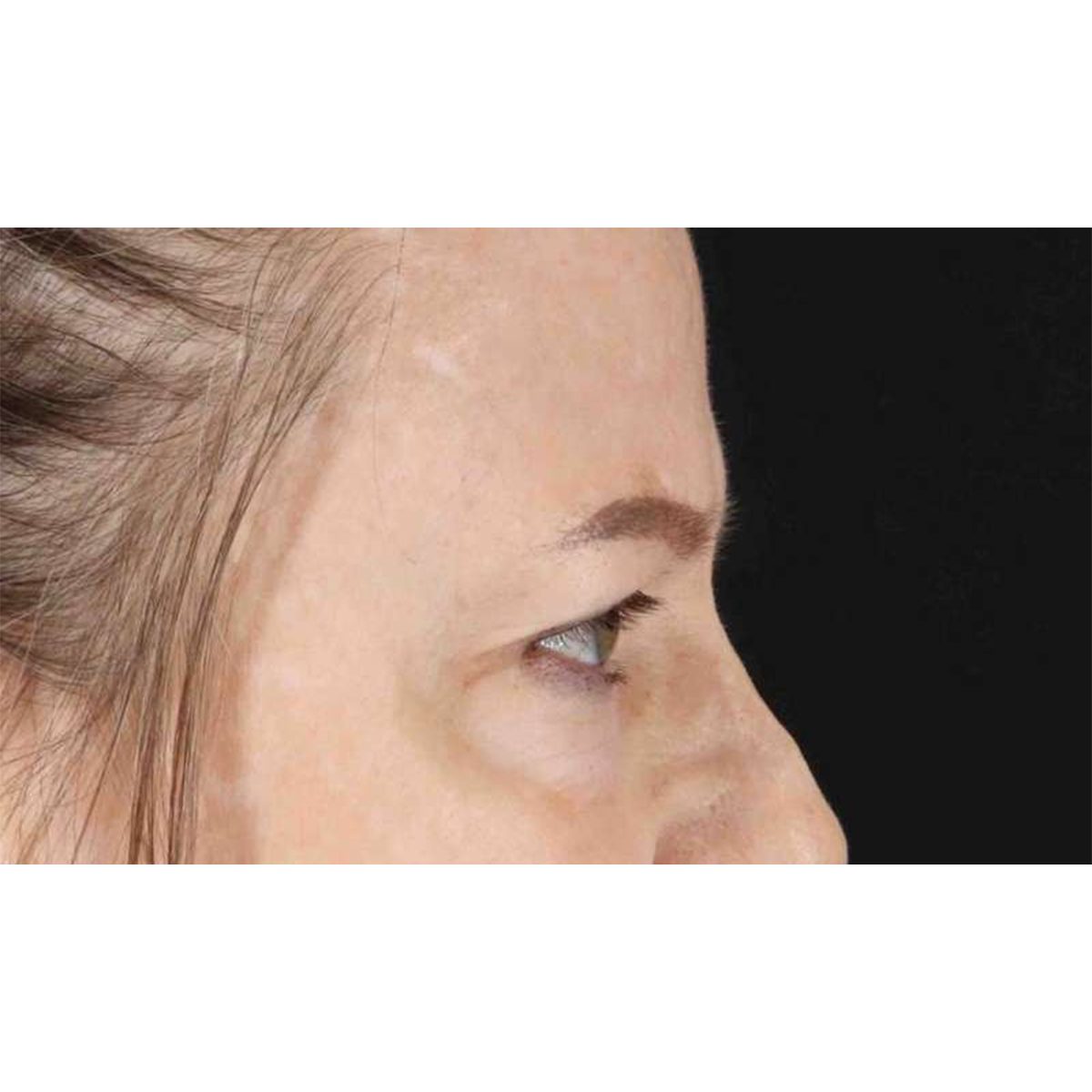 Blepharoplasty (Eyelid Surgery) Before & After Patient #10738