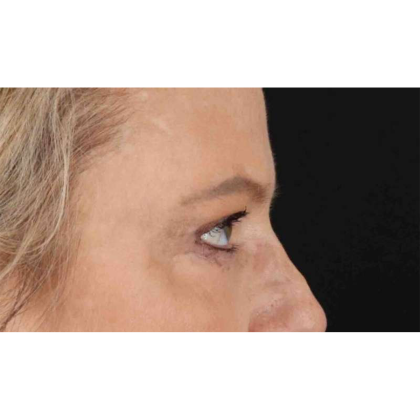 Blepharoplasty (Eyelid Surgery) Before & After Patient #10738