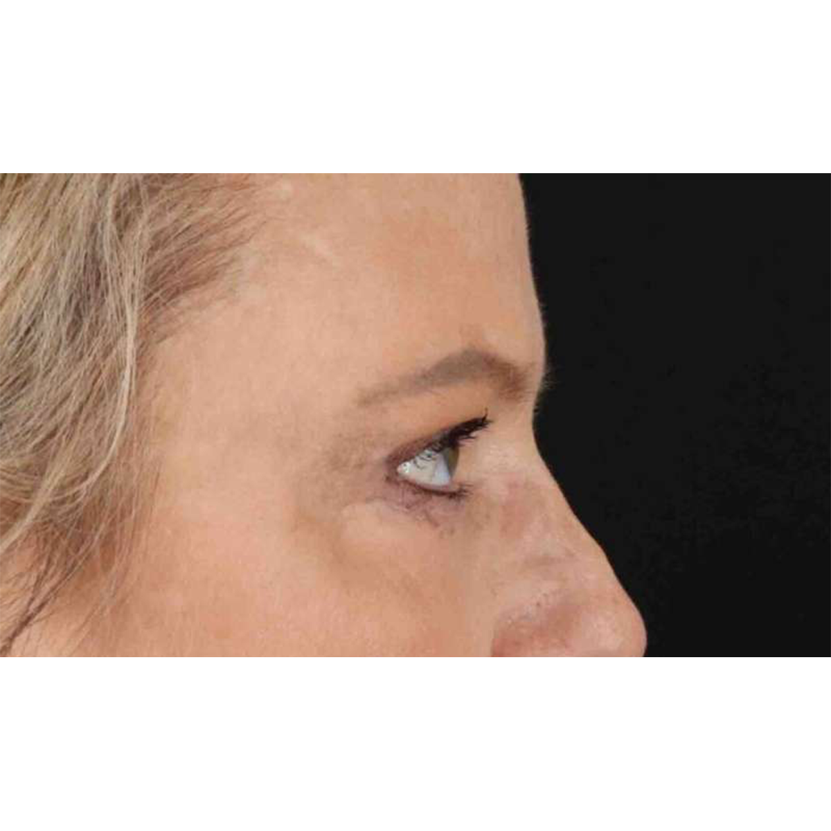 Blepharoplasty (Eyelid Surgery) Before & After Patient #10738