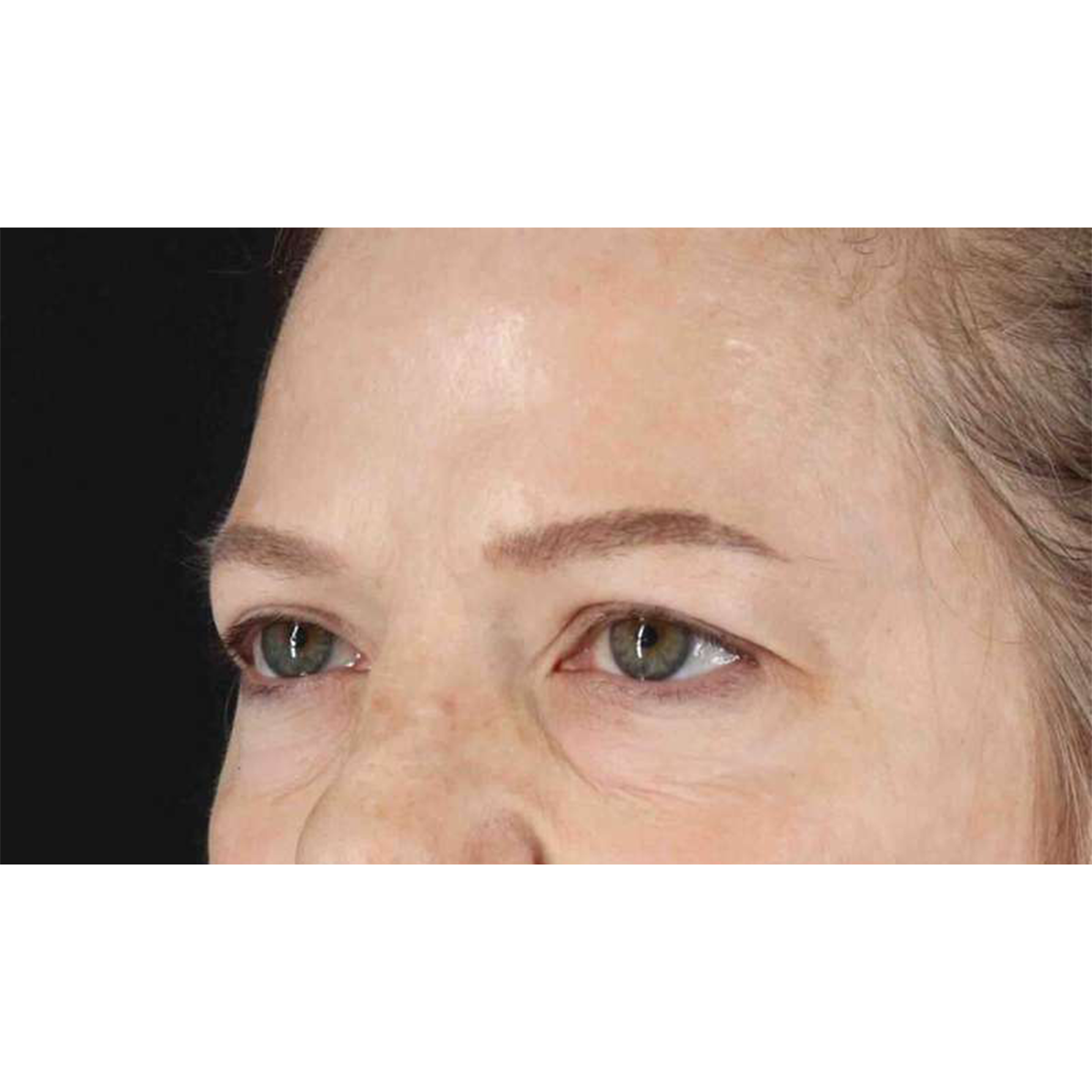 Blepharoplasty (Eyelid Surgery) Before & After Patient #10738
